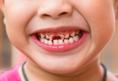  Sâu răng sữa ở trẻ nhỏ: Giải mã thắc mắc 